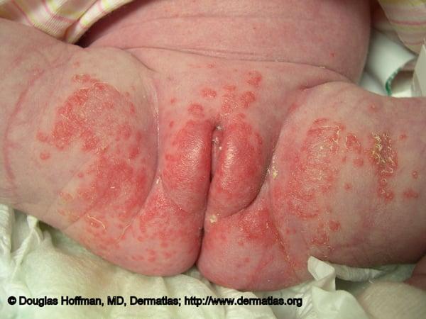 Understanding Diaper Dermatitis: Causes and Triggers