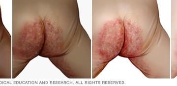 diaper dermatitis treatment